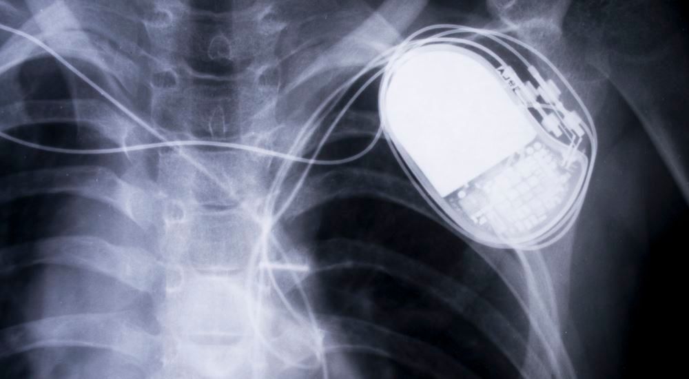 Photo of an x-ray of a pacemaker in a human chest