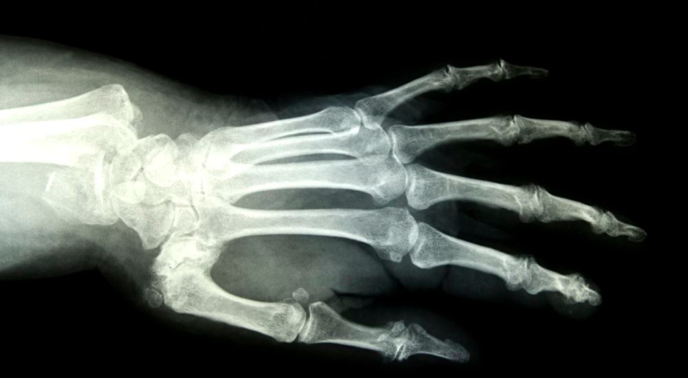 Photo of an x-ray of a human hand